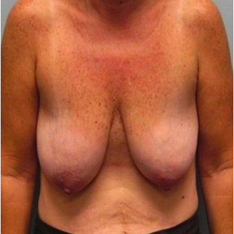 53 year old woman treated with Breast Lift with Implants before 3467402