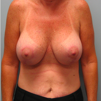 53 year old woman treated with Breast Lift with Implants after 3467402