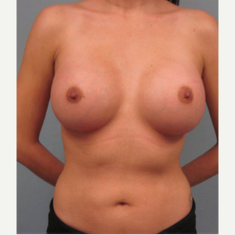 35-44 year old woman treated with Breast Augmentation after 1544377