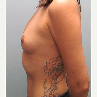 35-44 year old woman treated with Breast Augmentation 1544377
