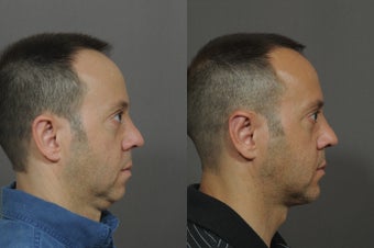 Chin Implant and Neck Tightening before 850324