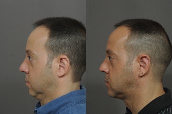 Chin Implant and Neck Tightening after 850324