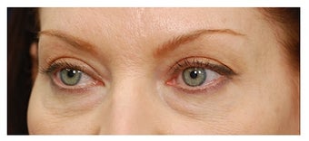Eye Bag Treatment before 1270460