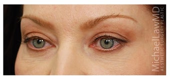 Eye Bag Treatment after 1270460