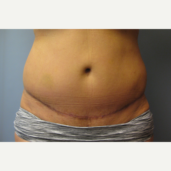 45 year old woman treated with Tummy Tuck after 3108246