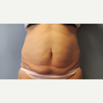 45 year old woman treated with Tummy Tuck before 3108246