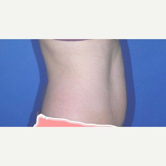 Liposuction before 3346206