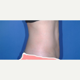 Liposuction after 3346206