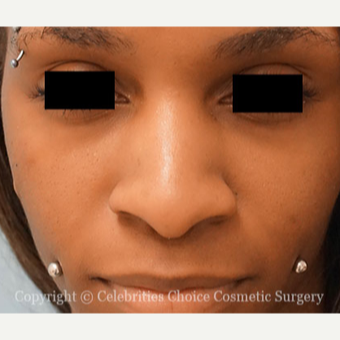25-34 year old woman treated with African American Rhinoplasty before 3853528