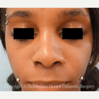 25-34 year old woman treated with African American Rhinoplasty after 3853528