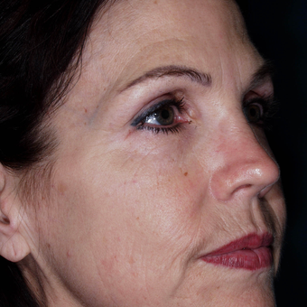 45-54 year old woman was treated to improve skin Wrinkles - wrinkle treatment after 3841214
