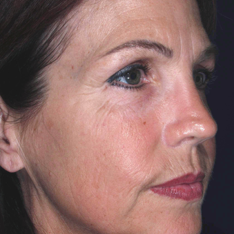 45-54 year old woman was treated to improve skin Wrinkles - wrinkle treatment before 3841214