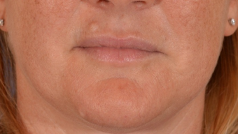 35-44 year old woman treated with Mole Removal of upper lip and chin before 1558495