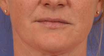 35-44 year old woman treated with Mole Removal of upper lip and chin after 1558495