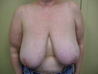 58 year old post mastectomy before 1355454