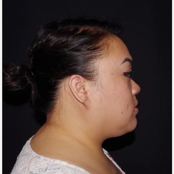 18-24 year old woman treated with Ear Lobe Surgery after 3741685