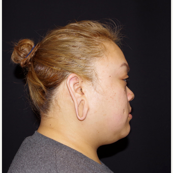 18-24 year old woman treated with Ear Lobe Surgery before 3741685