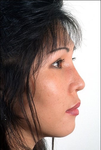 Rhinoplasty after 951816