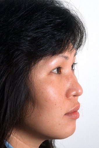 Rhinoplasty before 951816