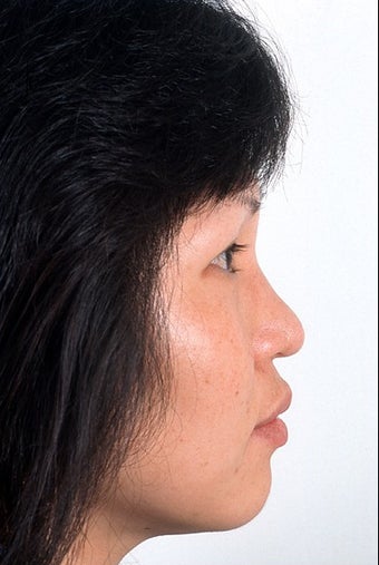 Rhinoplasty 951816