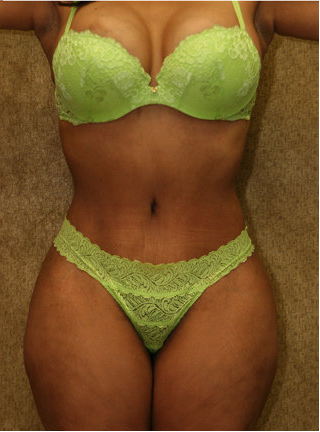 tummy tuck revision after 302681