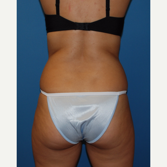 25-34 year old woman treated with SculpSure after 3411729