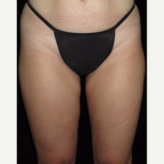31 year old woman treated with Liposuction of Thighs after 3251591