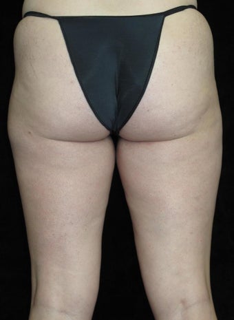 31 year old woman treated with Liposuction of Thighs 3251591