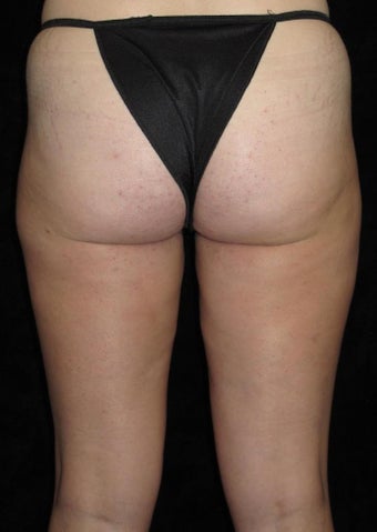 31 year old woman treated with Liposuction of Thighs 3251591