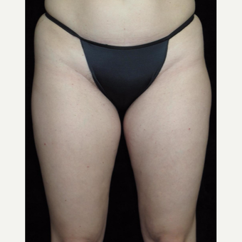 31 year old woman treated with Liposuction of Thighs before 3251591