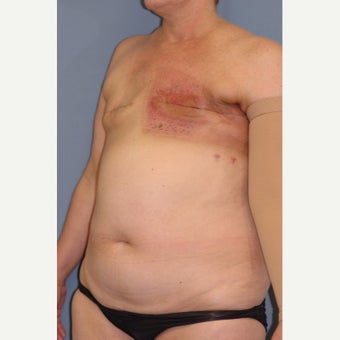 35-44 year old woman treated with Breast Reconstruction 1835990