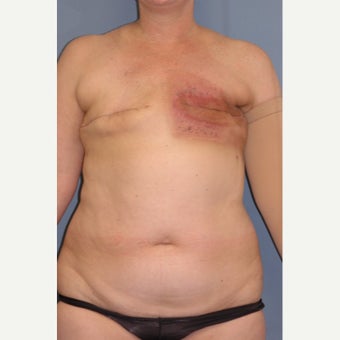 35-44 year old woman treated with Breast Reconstruction before 1835990