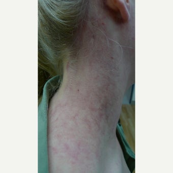 Port wine stain- fading with time after 2203277