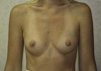 32 yr old female silicone gel implants 350cc sub-glandular before 972133