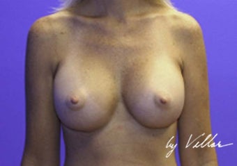 32 yr old female silicone gel implants 350cc sub-glandular after 972133