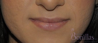 26 y/o female desired permanent lip augmentation. before 1137294