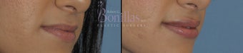 26 y/o female desired permanent lip augmentation. 1137294