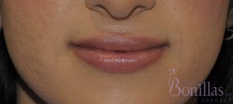 26 y/o female desired permanent lip augmentation. after 1137294