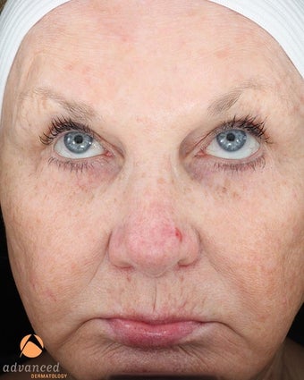Female treated with 3 Photodynamic Therapy with Levulan for Pre-Skin Cancer (AK's) before 1041650