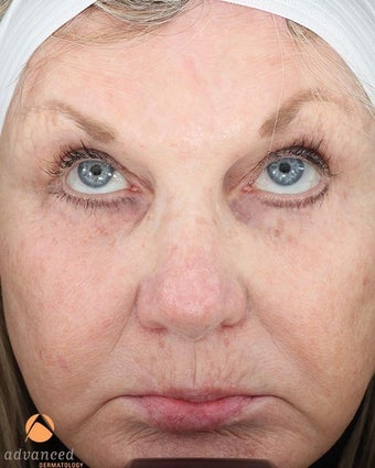 Female treated with 3 Photodynamic Therapy with Levulan for Pre-Skin Cancer (AK's) after 1041650