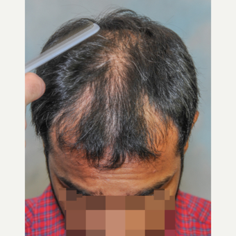 3000 Grafts 2 Year Results 25-34 year old man before 3466389