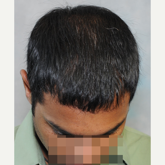 3000 Grafts 2 Year Results 25-34 year old man after 3466389