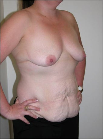 Mummy Makeover - abdominoplasty and breast augmentation before 996494