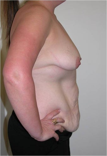 Mummy Makeover - abdominoplasty and breast augmentation 996494