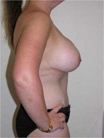 Mummy Makeover - abdominoplasty and breast augmentation 996494