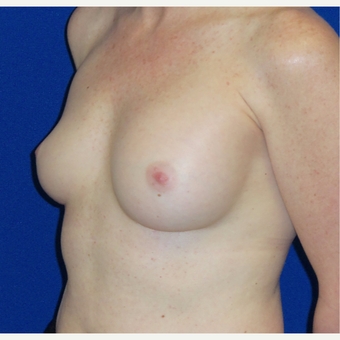 35-44 year old woman treated with Breast Implant Revision before 3820331