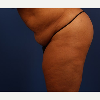 Liposuction before 3743886