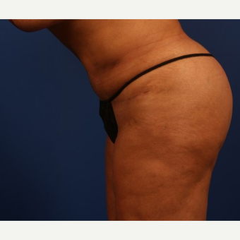 Liposuction after 3743886