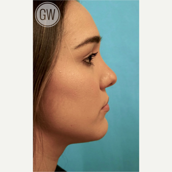 18-24 year old woman treated with Revision Rhinoplasty - Cleft rhinoplasty with fat grafting to lip after 3473500