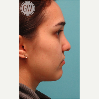 18-24 year old woman treated with Revision Rhinoplasty - Cleft rhinoplasty with fat grafting to lip before 3473500